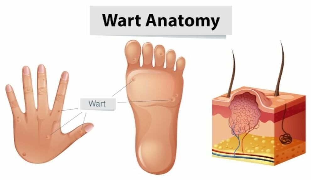 Successful elimination of warts along with the root with Removio