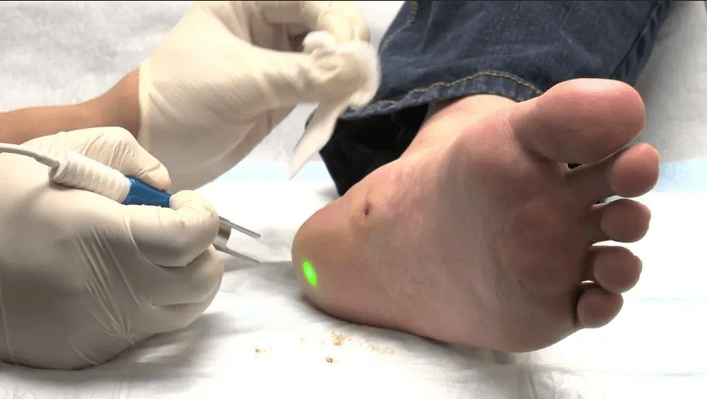 Plantar wart