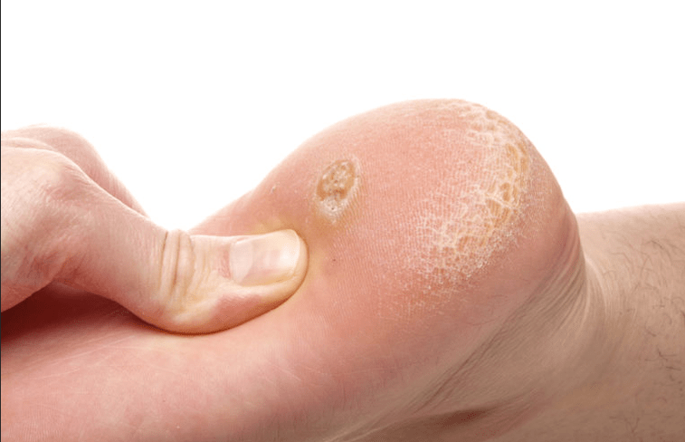 Wart