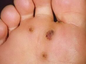How to get rid of a plantar wart