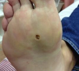 Ways to remove a wart on the sole of the feet