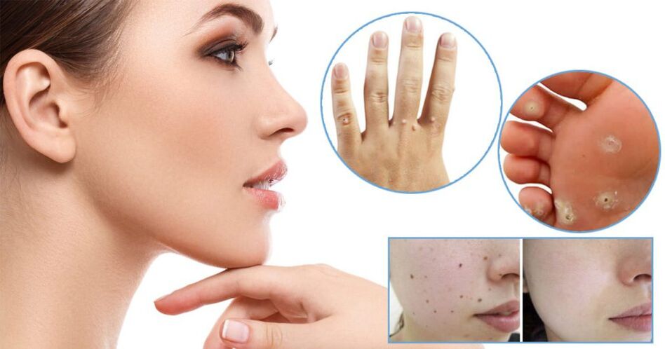 Methods to remove papillomas