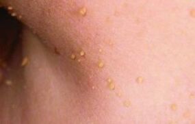 The reasons for the appearance of papillomas on the body