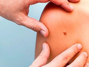 Causes of papillomas on the body