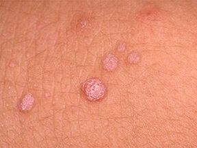 How to get rid of papillomas on the body