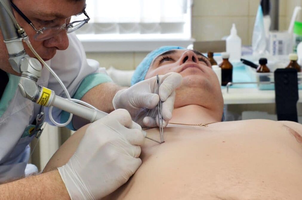 how to get rid of body warts