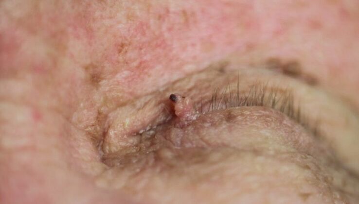 eyelid papilloma how to get rid of it