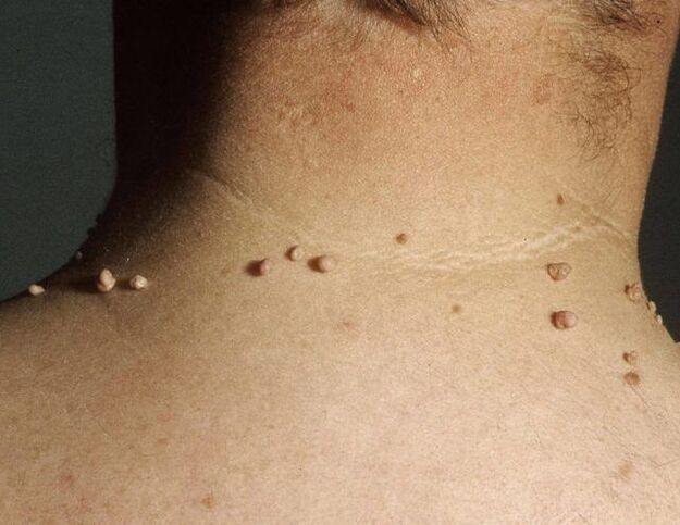 Papillomas on the neck of a man