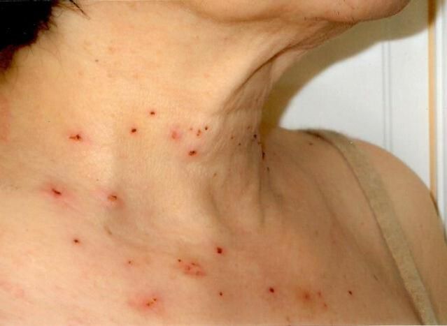 Results of the treatment of papillomas of the neck