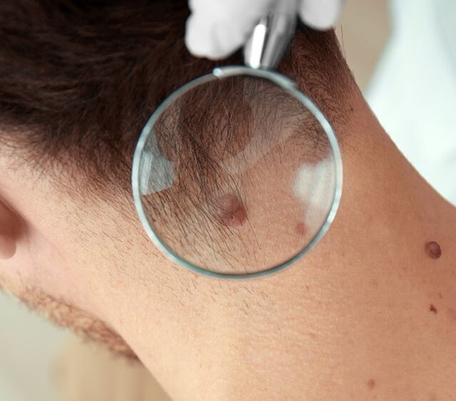 The doctor examines the papilloma of the neck