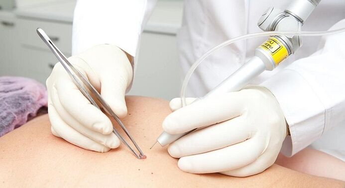laser removal of papilloma for papilloma virus