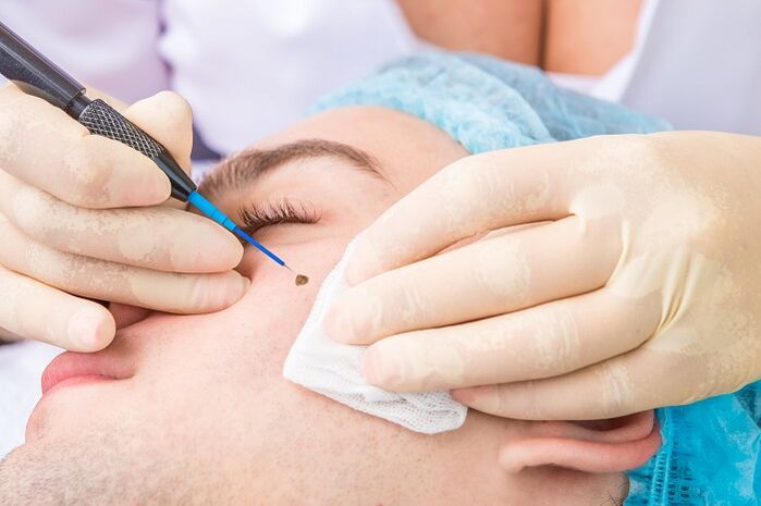 removal of papilloma on the face due to human papilloma virus