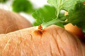 removal of papilloma with the juice of the herb celandine