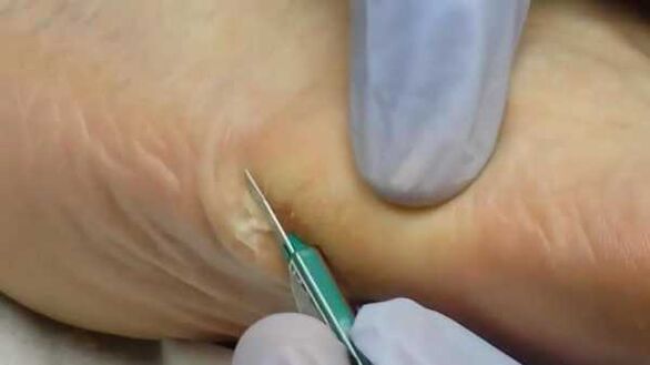 Surgical removal of plantar wart