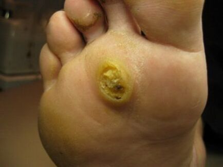 plantar wart