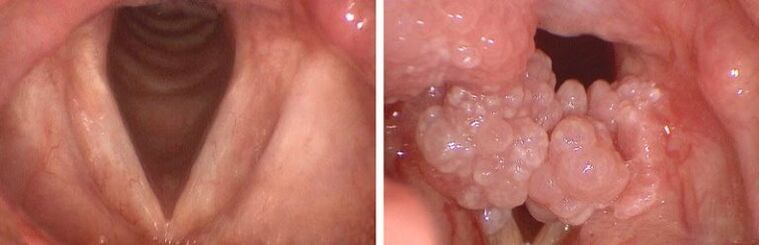 throat clearing and papillomas in the pharynx